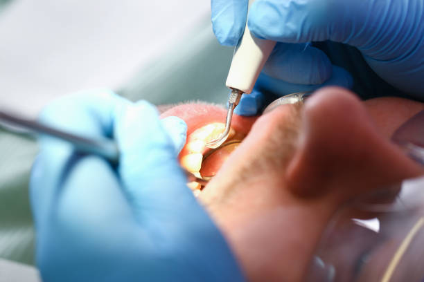 Best Emergency Tooth Extraction in Luna Pier, MI